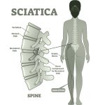 About Sciatica and Sciatic Nerve Pain