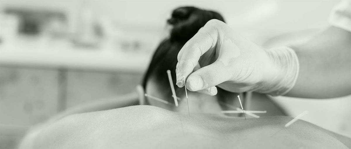 acupuncture needles pain treatments